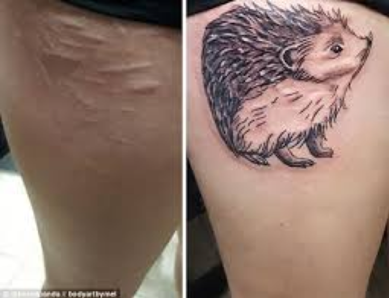 Tattooing scars and stretchmarks Timeless Tattoo 2025